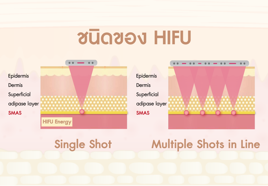 ชนิดของ HIFU แบบ Single Dot และ Multiple Dots in Line